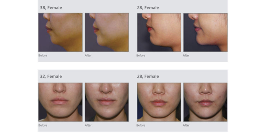 HyaFilia Medical Cross-Linked Hyaluronic Acid Dermal Filler HyaFilia Medical Cross-Linked Hyaluronic Acid Dermal Filler