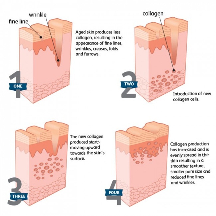 dermal filler