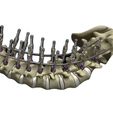 Cervical Vertebrae Posterior Titanium fixation Plate