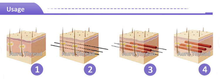 Face Lifting Needle