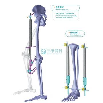 Minimally Invasive Reduction Frame for Fracture