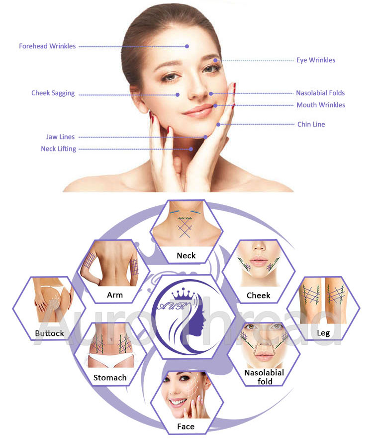 Hot Medical Skin Care Pdo Thread Lift Face