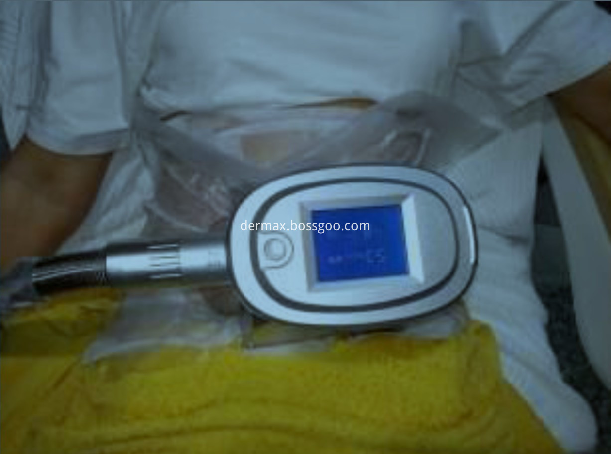 Cryolipolysis Antifreeze Membrane