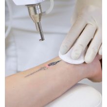 Remoção de tatuagem da Choicy Academy Treinamento online