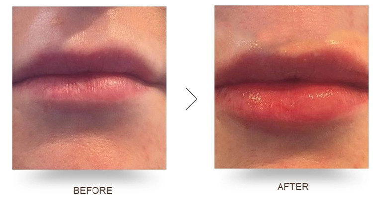 hyaluronic acid lip 