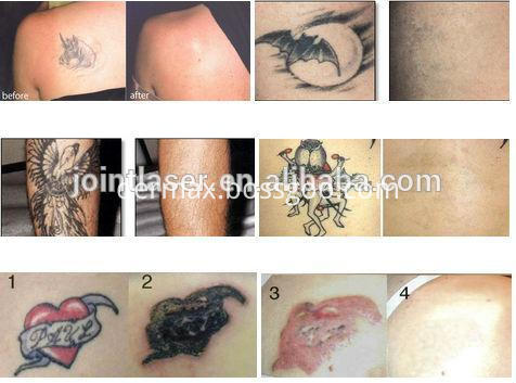 Effective Laser Tattoo Removal