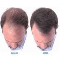 Empêcher la perte de cheveux sébacée Minoxidil Powder CAS 38304-91-5