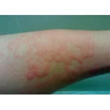 (L-Cysteine) --Treatment of Skin Disease L-Cysteine