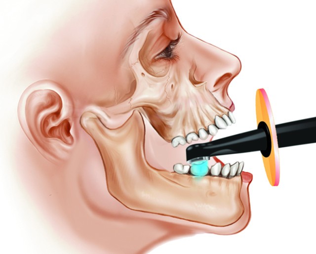 High Quality Built in Type Dental LED Curing Light