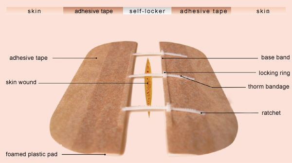 Medical Disposable-No Needleless Suture Equipment