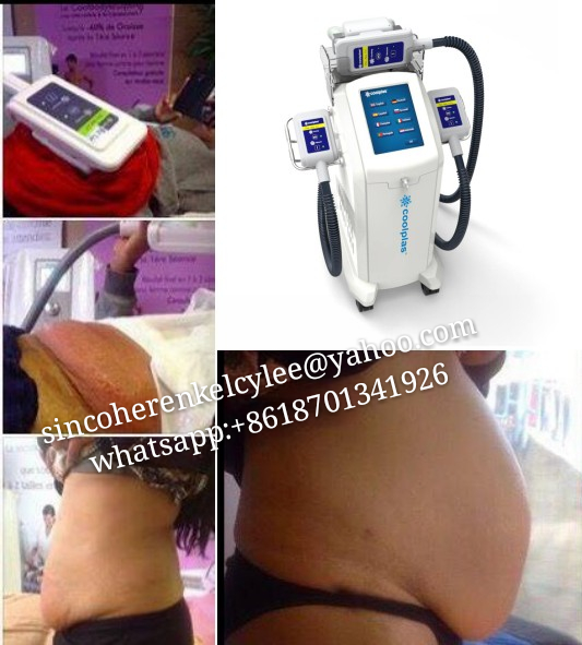 Zeltiq Coolsculpting Slimming Machine & Fat Freezing Cryolipolysis Slimming Beauty Machine