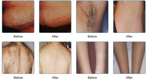 2016 Diode Laser Shr Fast for Hair Removal