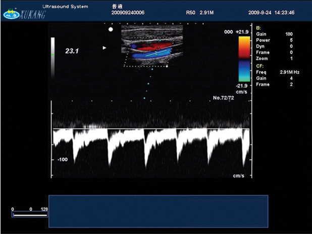 Trolley Ultrasound Machine Color Doppler (XT-FL036)