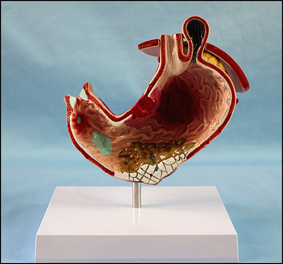 Human Stomach with Ulcers Anatomical Model