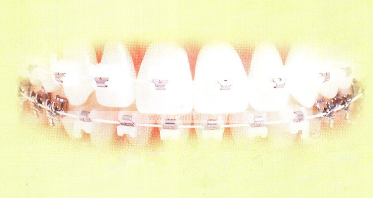 Round / Rectangular Tooth Color Invisible Coated Niti Arch Wires