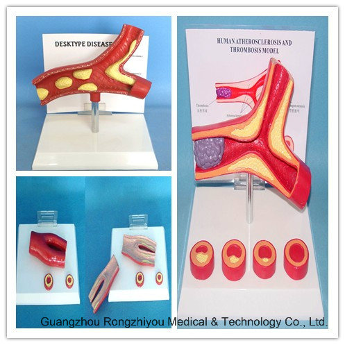 Desktype Arteriosclerosis Model, with Cross Section of Artery, 2 Part