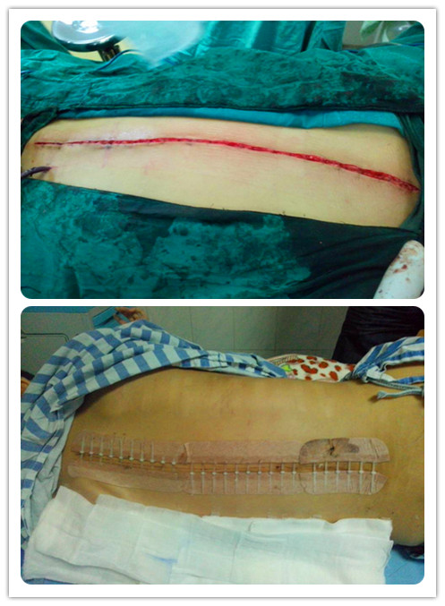 Therapeutic Suture with No Needle Suture Technology