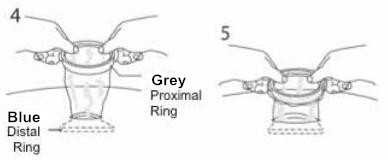 Disposable Wound Retractor for Endoscope Surgery