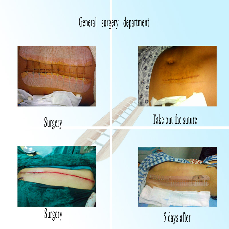 Medical Disposable-No Needleless Suture Equipment