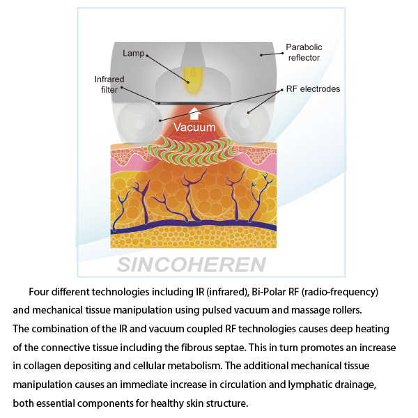 Sincoheren Vacuum Suction Radio Frequency Equipment for Cellulite Reduction