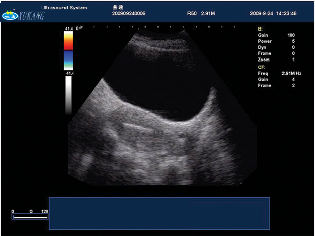 Trolley Ultrasound Machine Color Doppler (XT-FL036)