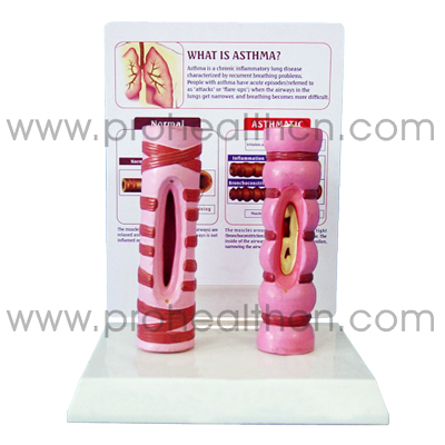 Asthma Model (PH6059)