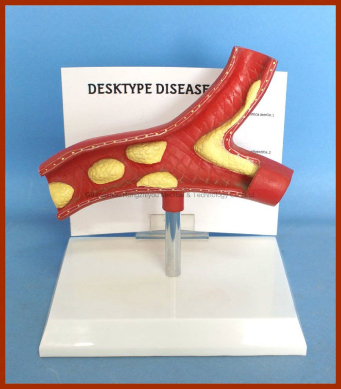 Desktype Disease Artery Anatomical Model Pathological