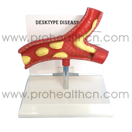 Desktype Disease Model (PH6058)