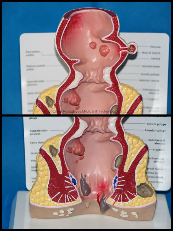 Pathological Model Rectum Anatomical Model