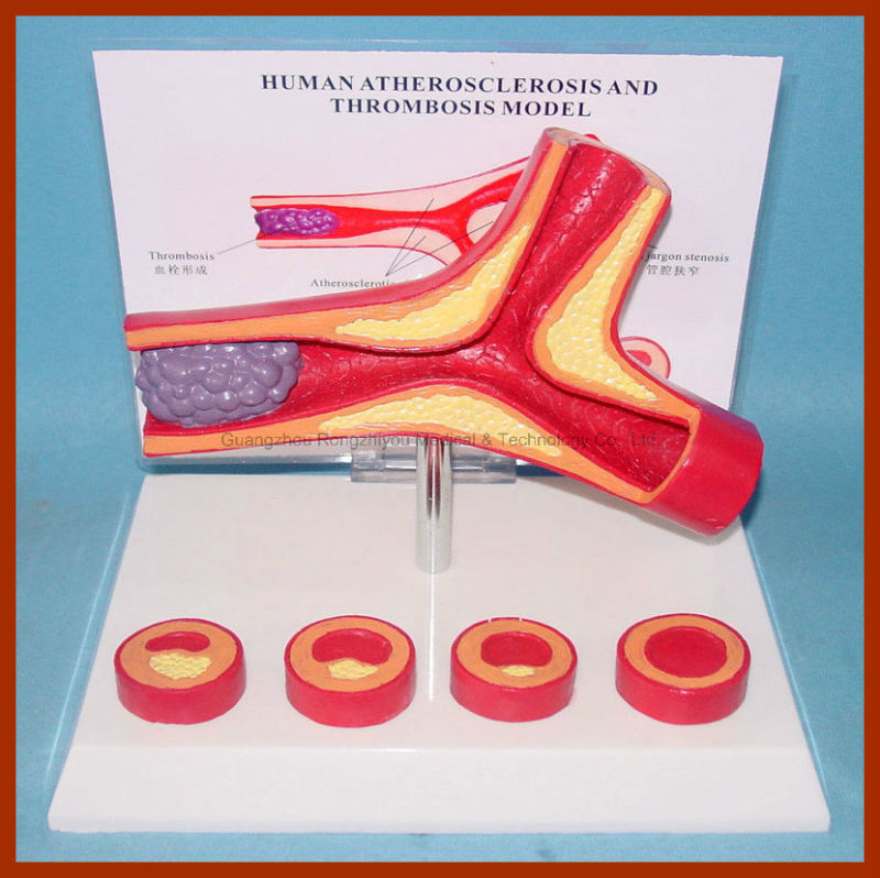New Desktop Education Anatomy Human Disease Anatomical Model Artery for Patient
