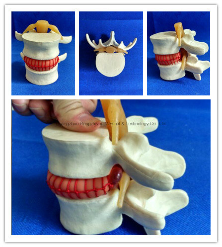 Enlarge Demonstration Lumbar Disc Herniation Model