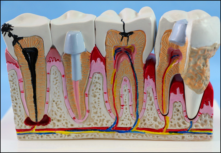 Dental Care Pathological Tooth Anatomical Model