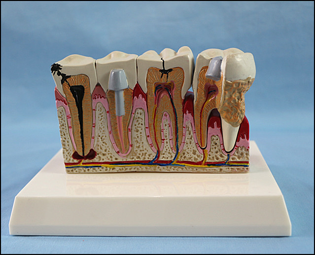 Dental Care Pathological Tooth Anatomical Model