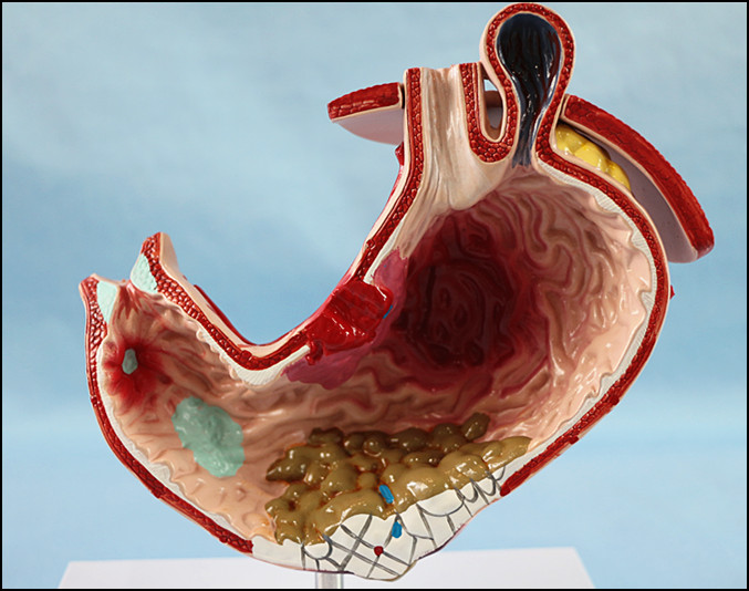 Human Stomach with Ulcers Anatomical Model