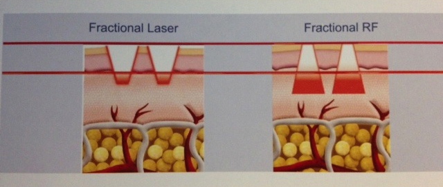 Fractional RF Skin Tighting/Skin Care Machine