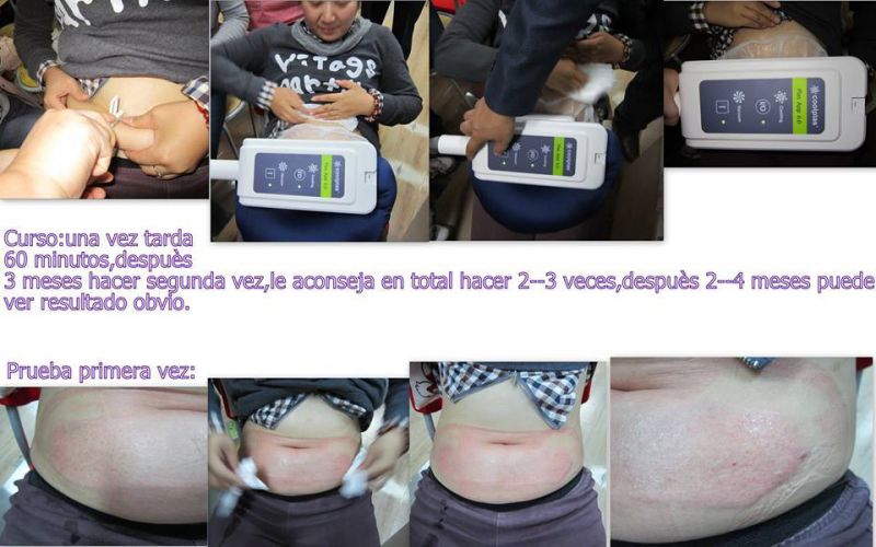 Liposuction for Body Contour Weight Loss and Fat Reduction Device