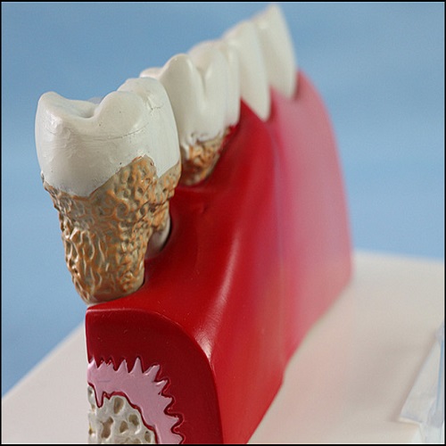 Dental Care Pathological Tooth Anatomical Model