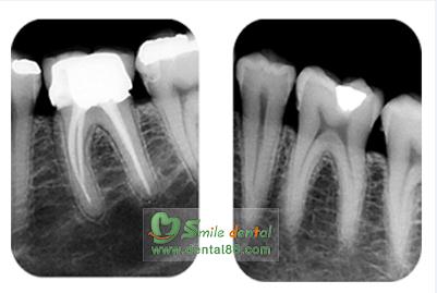 0.8mm Focus Wall-Mounted X Ray Machine with CE