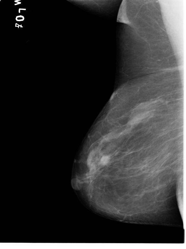 Xm30 Mammography X-ray