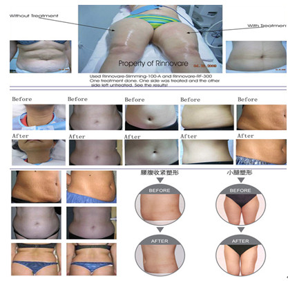 Beijing Sincoheren Kumashape Cellulite/Fat Reduction Slimming Therapy Machine