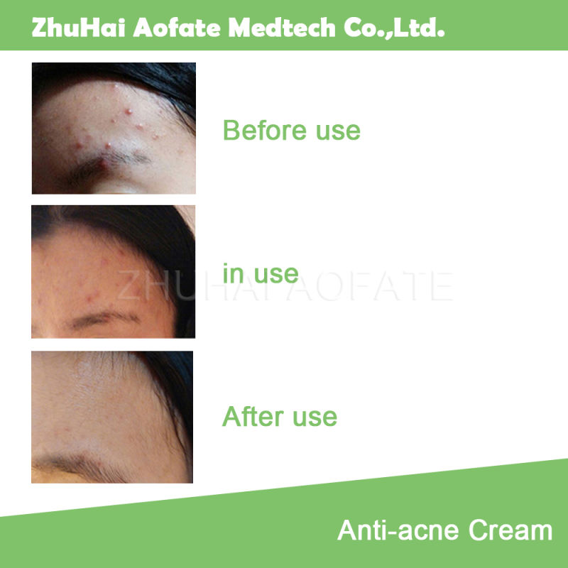 Anti-Acne and Pimple & Skin Care Face Cream