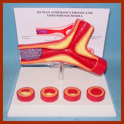 Human Artery Atherosclerosis and Thrombosis Model