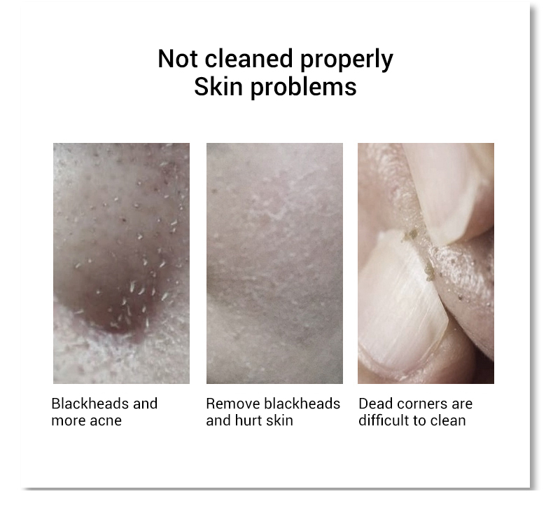 New Product Electric Black Head Remover Vacuum New Product Electric Black Head Remover Vacuum