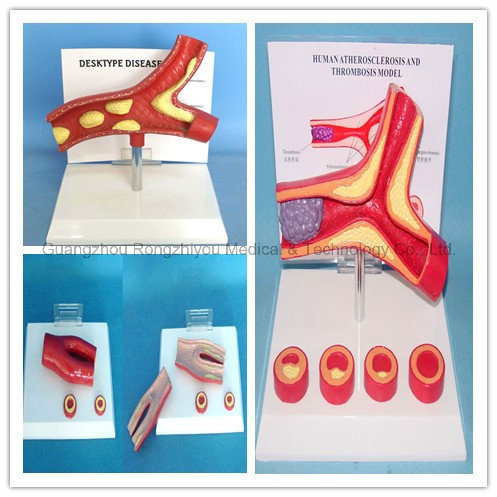 New Desktop Education Anatomy Human Disease Anatomical Model Artery for Patient