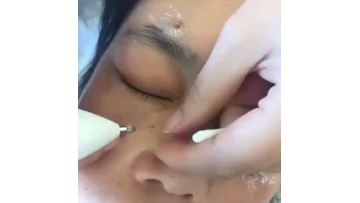3 level Led Plasma Facial Freckle Mole Tag Wart Removal Pen Dark Spot Remover1