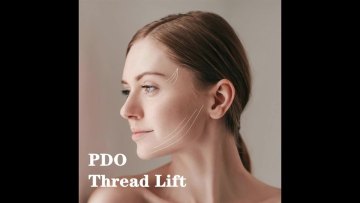 Obvious effective high quality face thread lift pdo plla threads  pdo 30g 50mm1