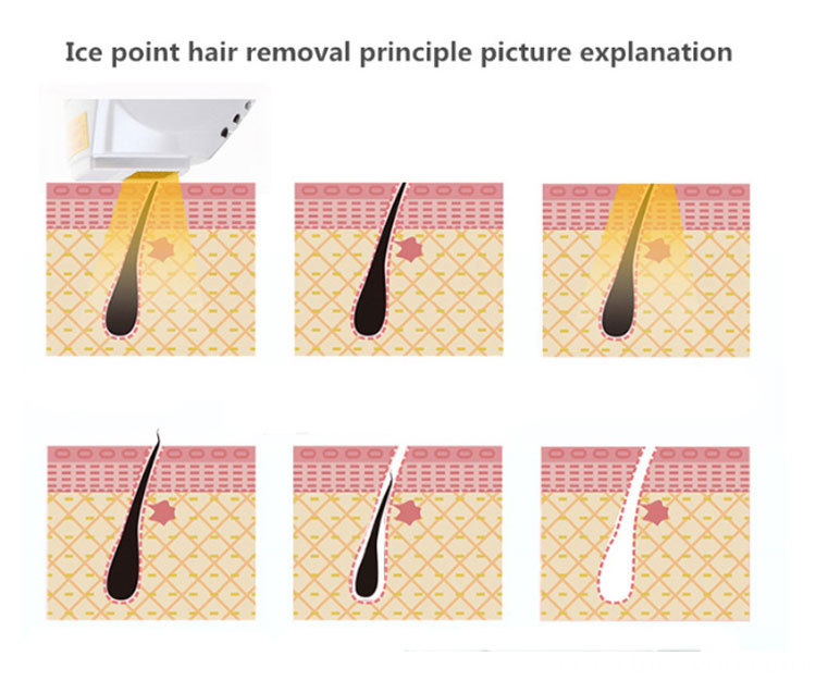 Remover Hair Laser