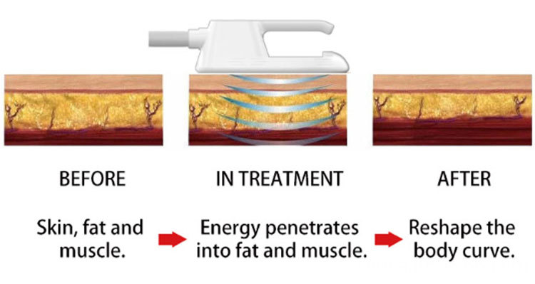 Ems Body Sculpting Equipment